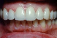 Ästhetisches Veneering