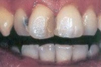 Verfärbte Frontzähne