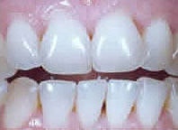 Gesunde Zähne - Prophylaxe Braunschweig Saubere, gereinigte Zähne