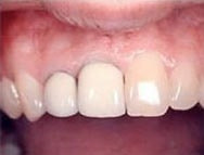 Vollkeramikkrone neben echten Zähnen Vollkeramikkrone neben echten Zähnen