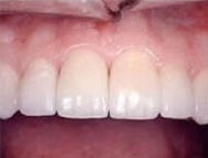 Vollkeramikkronen schmiegen sich ins Gesamtbild Vollkeramikkronen schmiegen sich ins Gesamtbild