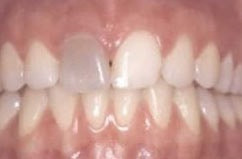 Bleaching eines Einzelzahns Einzelner dunkler Zahn nach Wurzelbehandlung