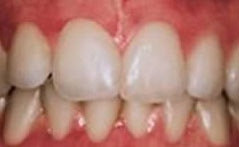 Zahnbleichen Braunschweig Zähne vor einem Bleaching