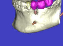 Computer-3D-Planung - Implantation Braunschweig Schematische Darstellung des Unterkiefers mit Implantaten