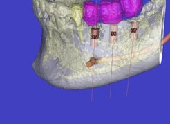 Computernavigierte Planung der Implantation Transparente Darstellung des Kiefers mit Blick auf die Schraubimplantate