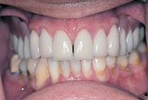 Herausnehmbarer Zahnersatz ohne Klammern Herausnehmbarer Zahnersatz ohne Klammern