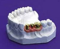 Goldbrücke - Zahnarzt Braunschweig Goldbrücke in einem Unterkiefer-Modell