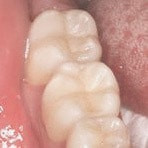 Zahnerhaltung mit Keramikfüllung Inlays aus Vollkeramik